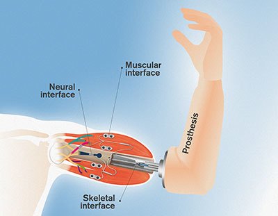 A diagram showing how the prosthesis interfaces with the nerves and muscles to allow users to control it with their mind