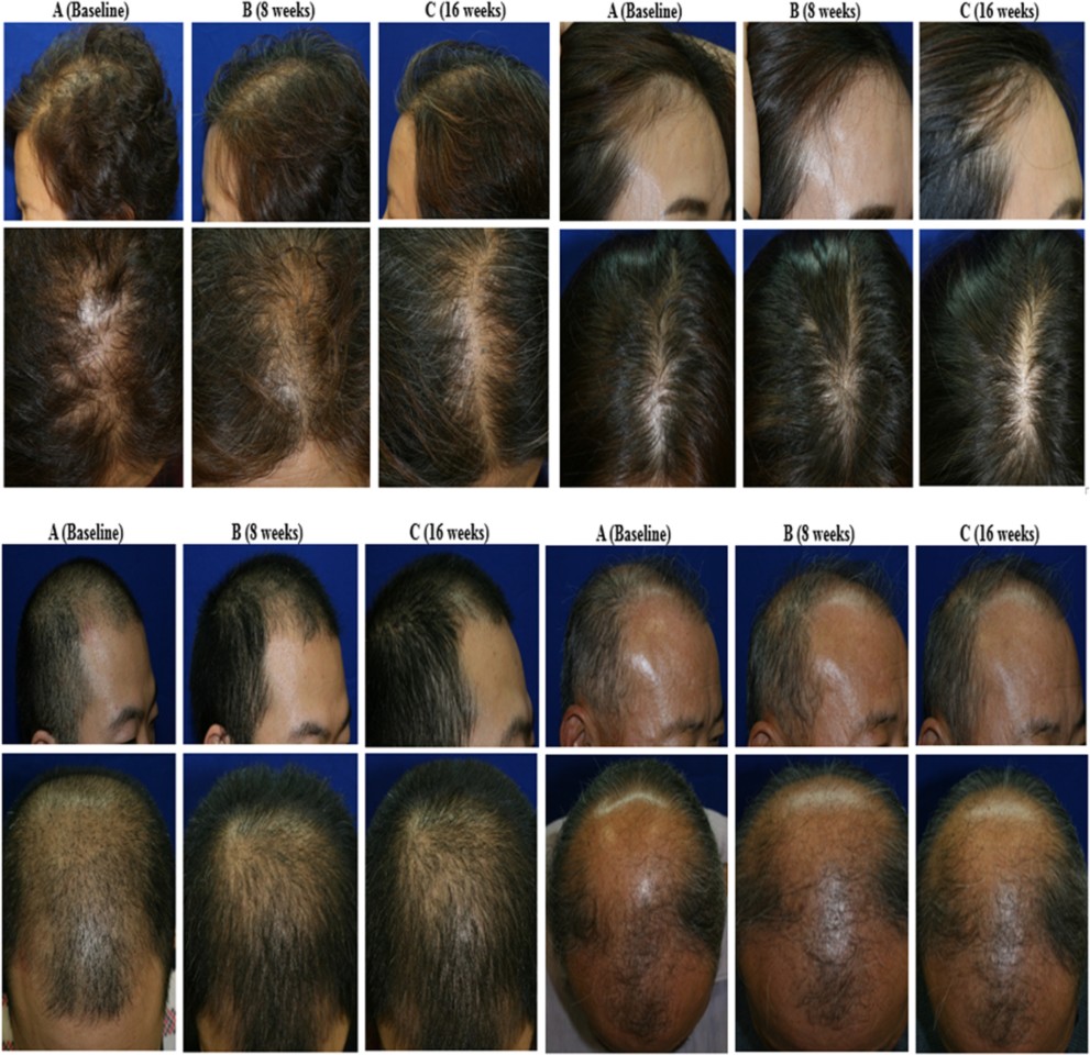 From baseline to 16 weeks – the two sets of photographs on the left are from subjects using the topical solution and on the right, subjects in the placebo group