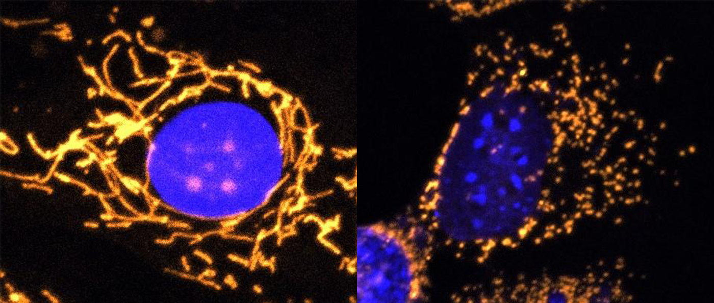 In cells mitochondria, highlighted in gold, should form healthy networks (left), but in DOA patients they can become fragmented (right)