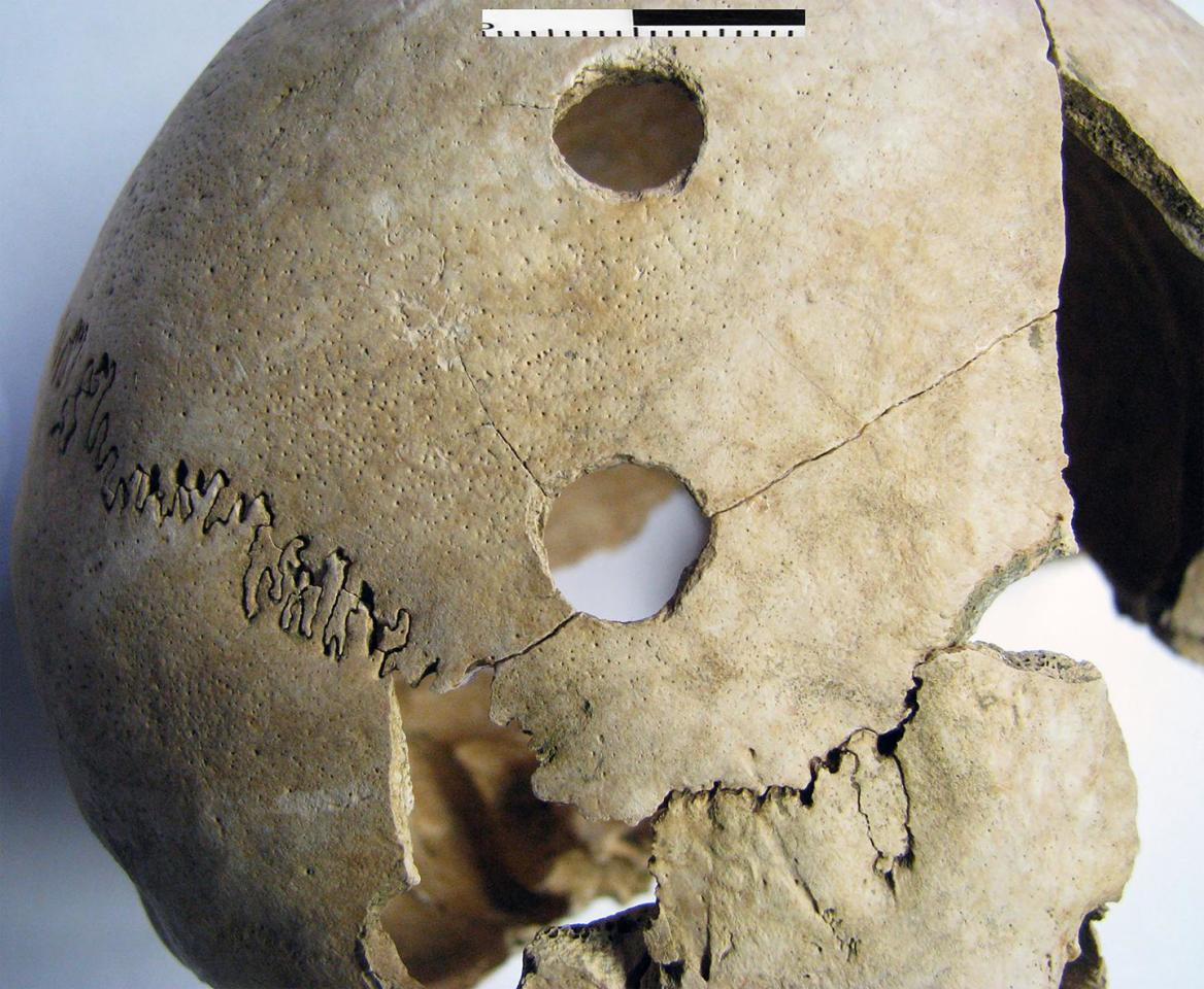 This photo shows penetrating injuries on the right side of the skull of a young adult female