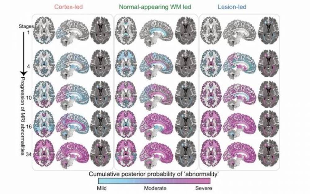 MRI brain scans of MS patients, based on the newly identified subtypes