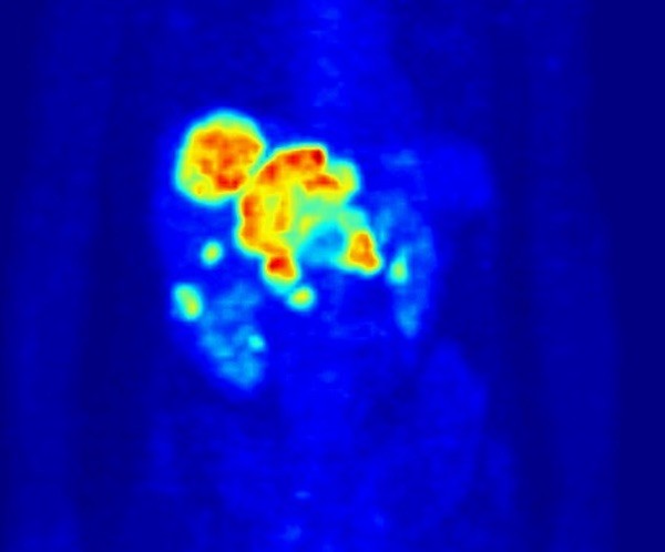 A PET scan of a patient, showing normal accumulation of the tracer dye in the heart and kidneys, as well as a tumor in the liver