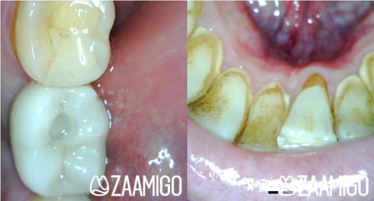 Examples of the Zaamigo's tooth pics