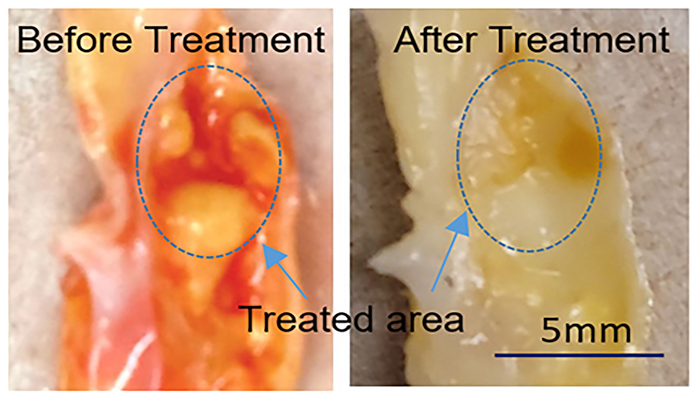 Arteries treated with the novel ultrasound-assisted laser technique, both before and after