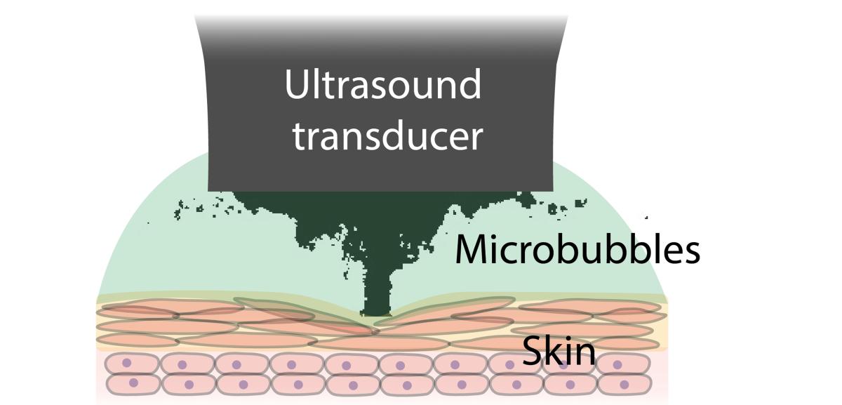 A diagram depicting the hydrogel-to-skin bonding process