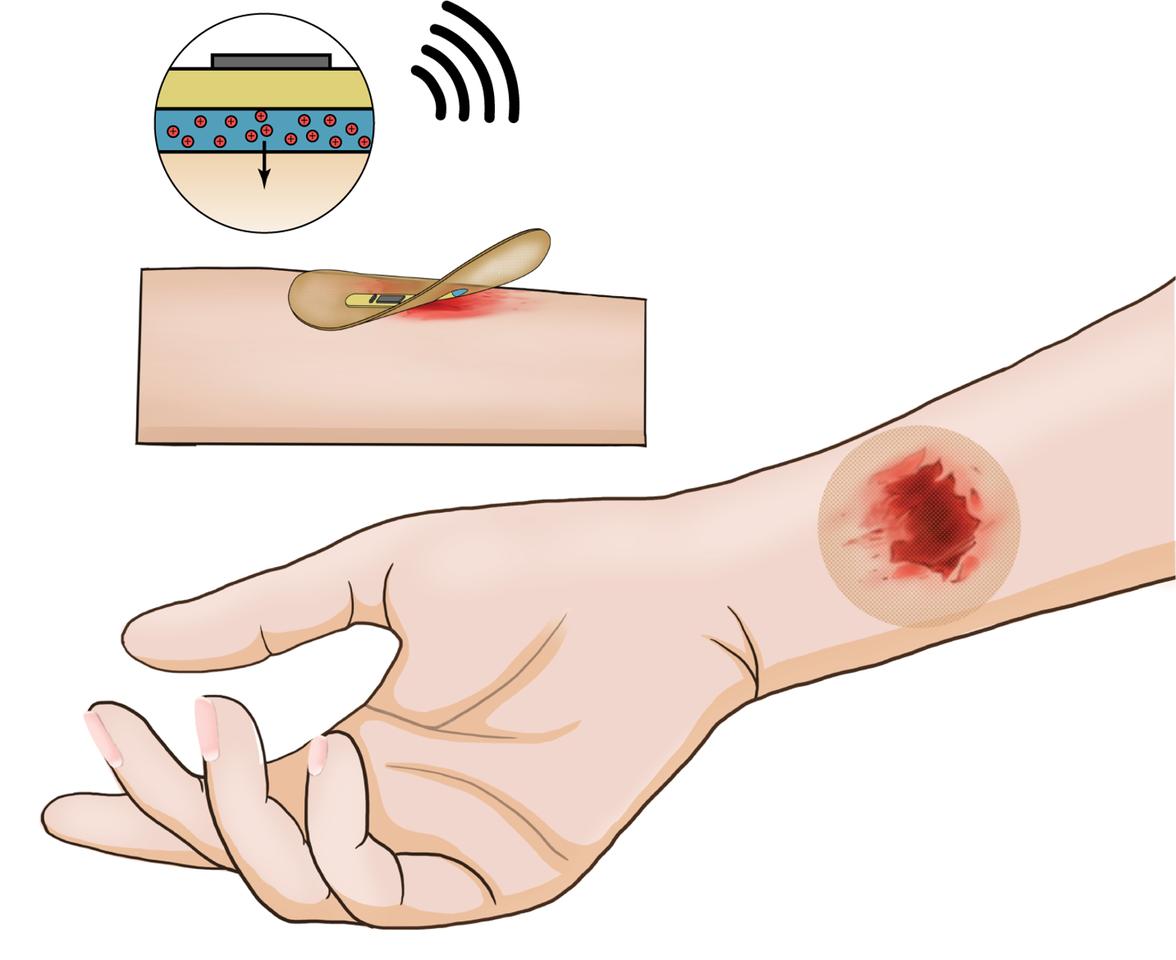 A diagram illustrates how the bandage would be applied to a chronic wound