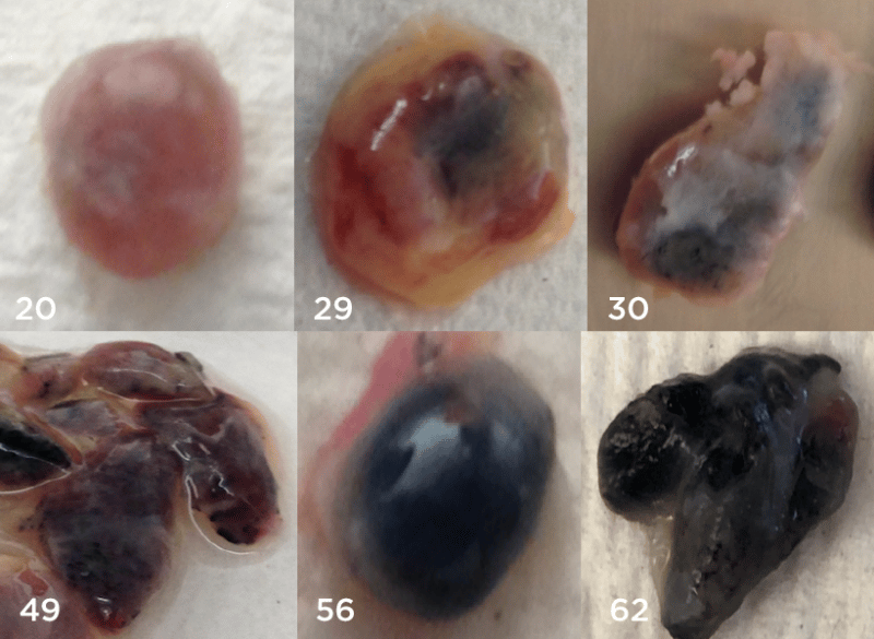 Lung lymph nodes from six non-smokers between the ages of 20 and 62. Particles of air pollution darken the lymph nodes and impair immune cells within the nodes.