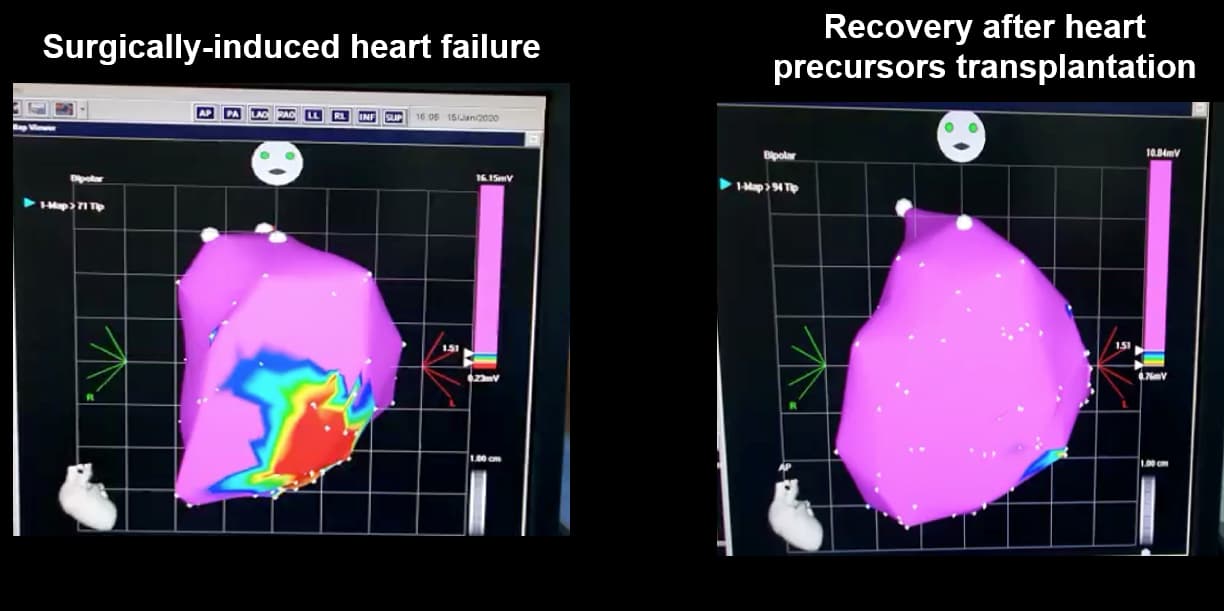 Electro-anatomical maps of a pig heart before (left) and after (right) transplantation of precursor stem cells. Areas in purple represent healthy tissue, while areas in other colours show injured tissue.