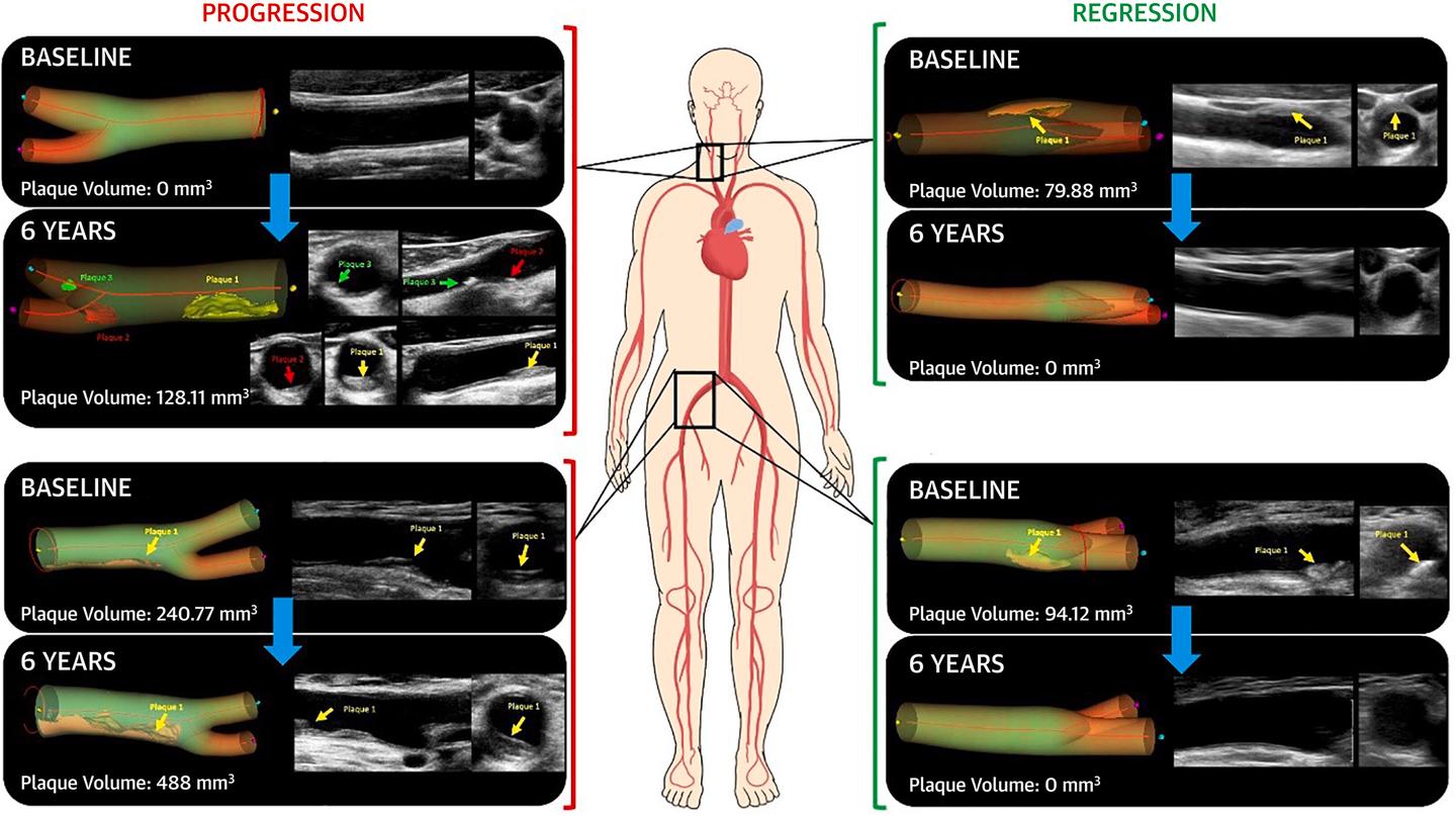Participant examples of six-year subclinical atherosclerosis progression and regression
