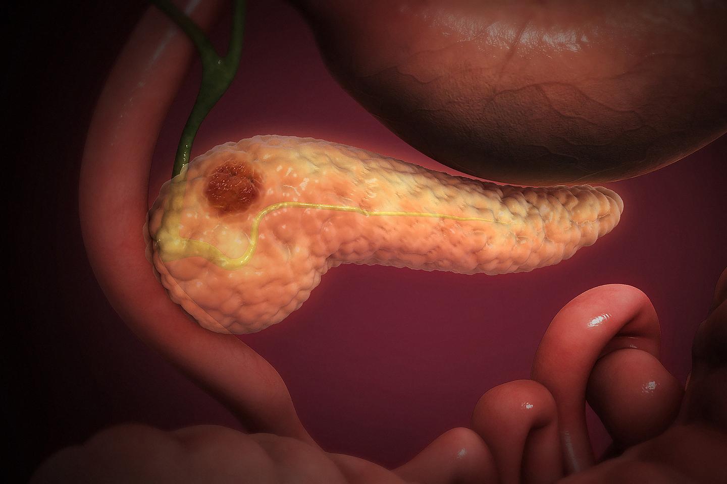 Researchers exploited the unique properties of pancreatic tumors to slow their growth
