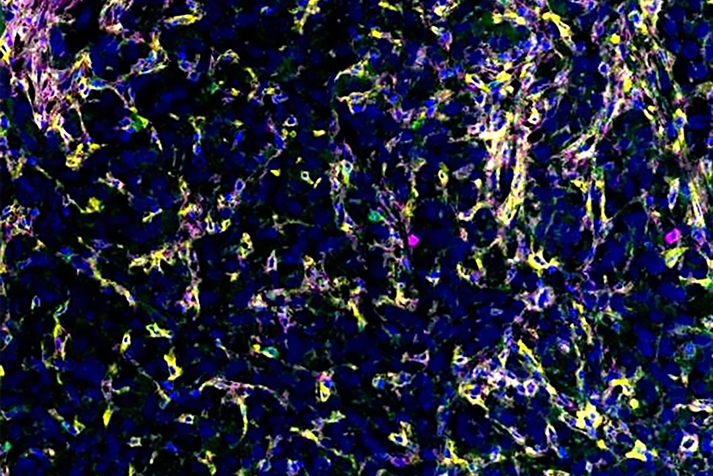 The TB vaccine shrank liver cancer tumors in mice