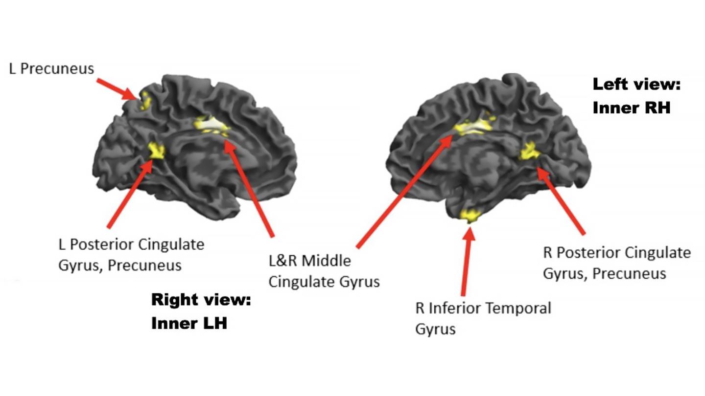 Inner views of the left and right sides of the brain showing areas of reduced brain activity when the high-experience musicians were in a high-flow state (compared to a low-flow state). These areas include key nodes of the brain’s default-mode network.
