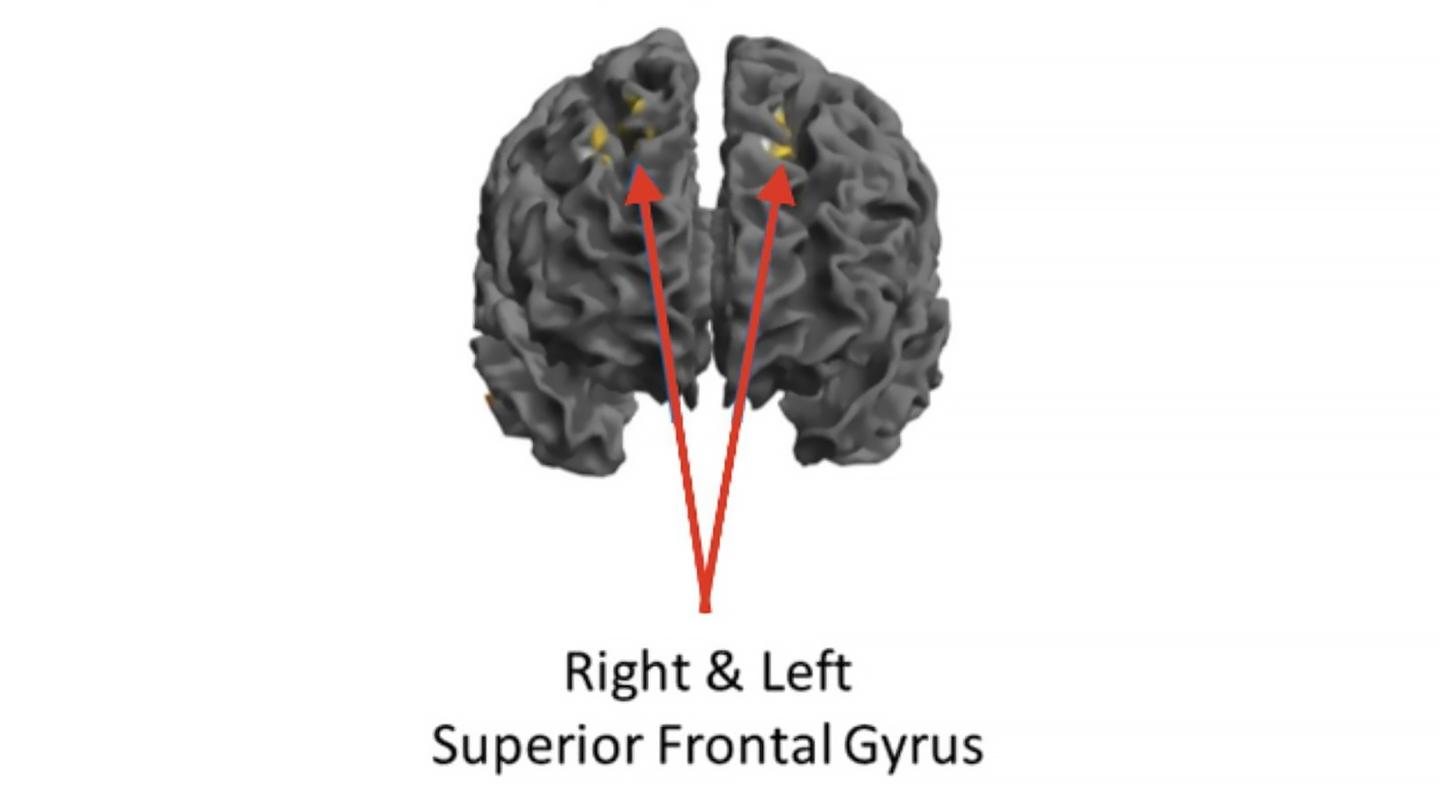 Front view of the brain. The jazz musicians showed reduced activity in these frontal-lobe areas when in a high-flow state