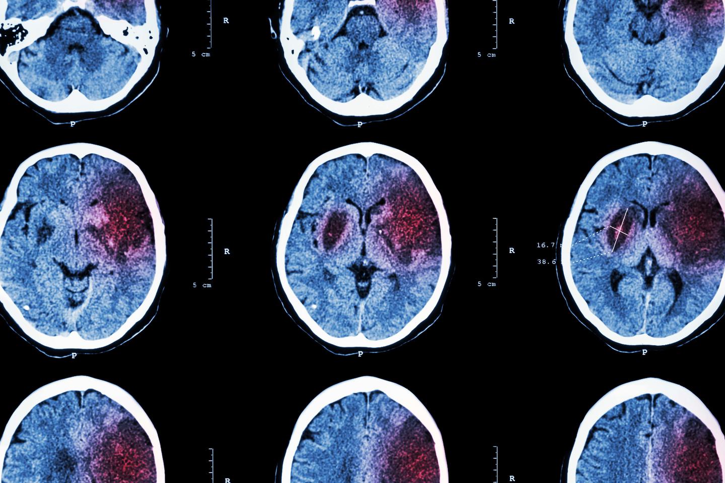 Treatment with IGF-1 reduced the area that had been starved of blood, oxygen and nutrients because of the stroke