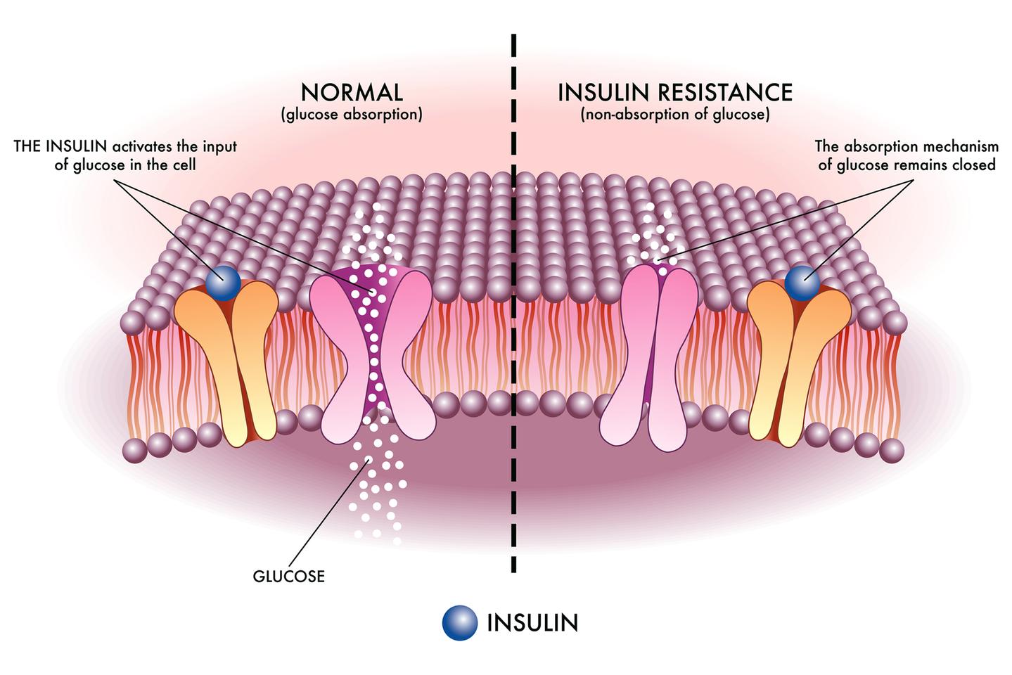 Insulin resistance is a feature of prediabetes