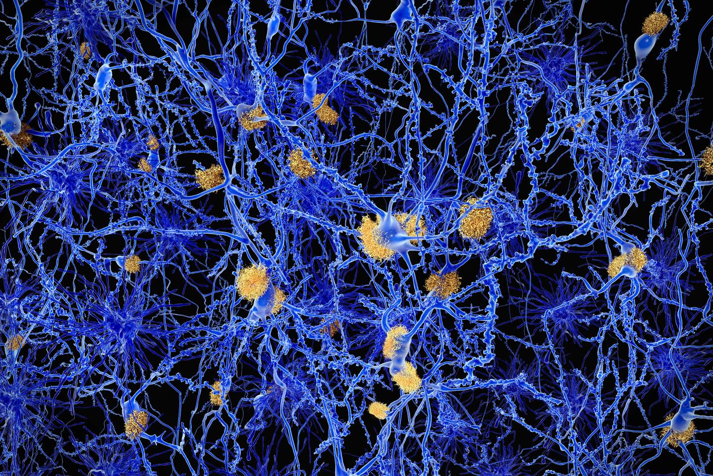 Growing evidence suggests looking beyond the current theory that focuses on accumulated amyloid-beta plaques