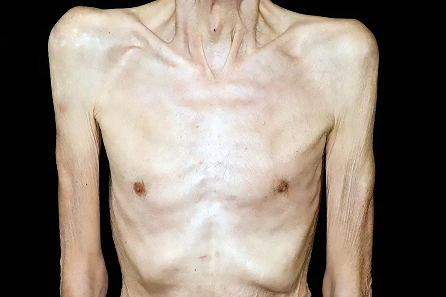Cachexia is a wasting condition where people lose body fat and muscle despite how much they eat